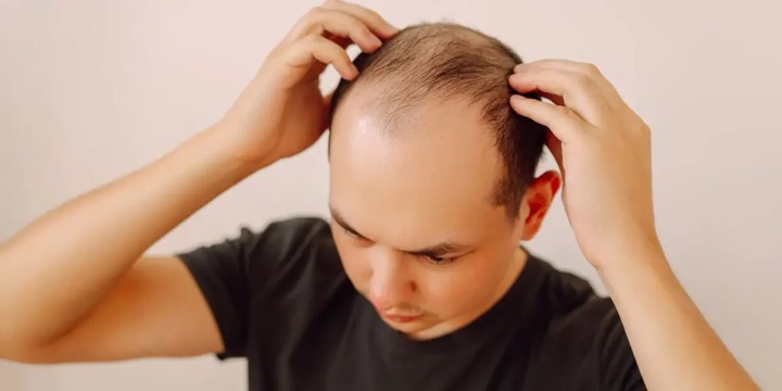 The Impact of Stress on Your Hair and How to Combat It