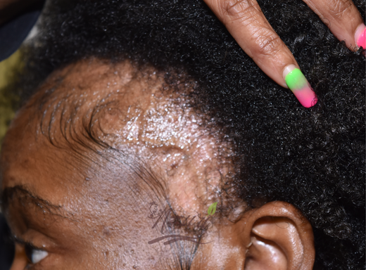 Before and after hair result showing improved fullness