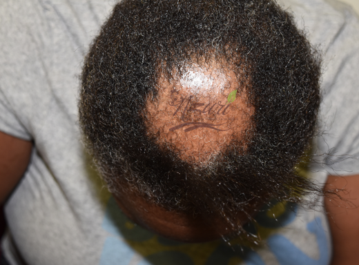 Before and after scalp result showing reduced flakes