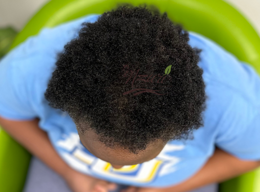 Before and after scalp result showing reduced flakes