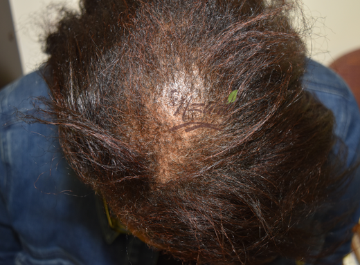 Before and after crown result showing improved fullness